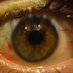 My Lasik Laser Eye Surgery Experience Journal